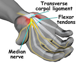 Carpal Tunnel Syndrome